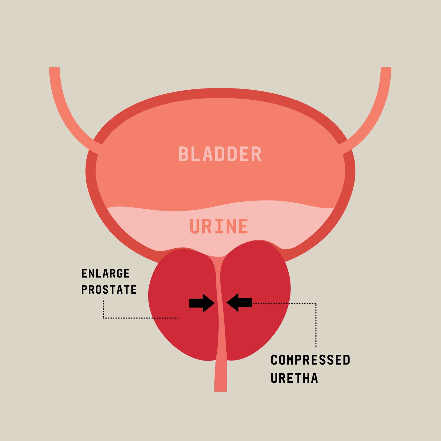 Incomplete emptying of the bladder, Blood in the urine, Recurrent urinary tract infections, Frequent sharp pain