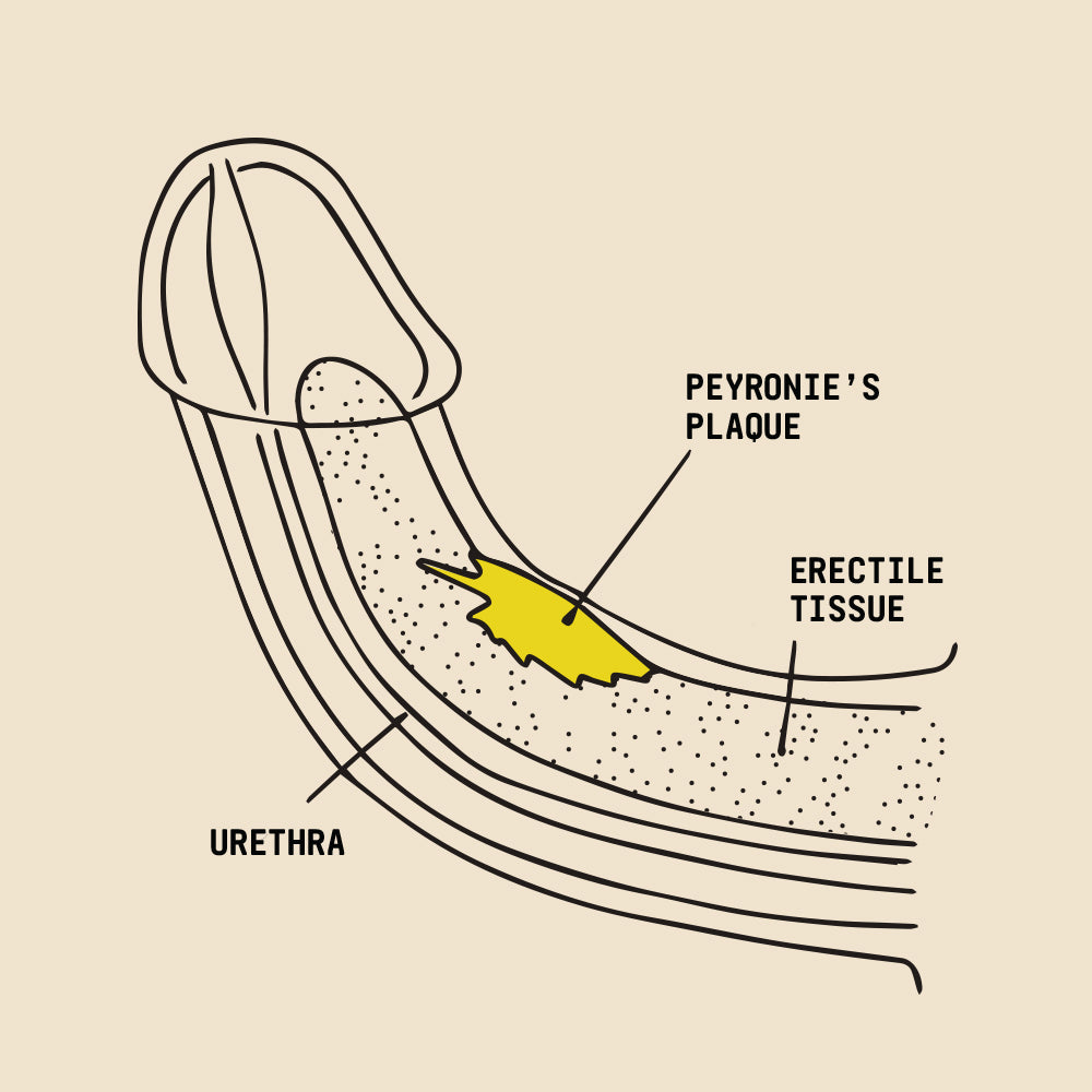 Peyronie’s plaque, urethra, erectile tissue